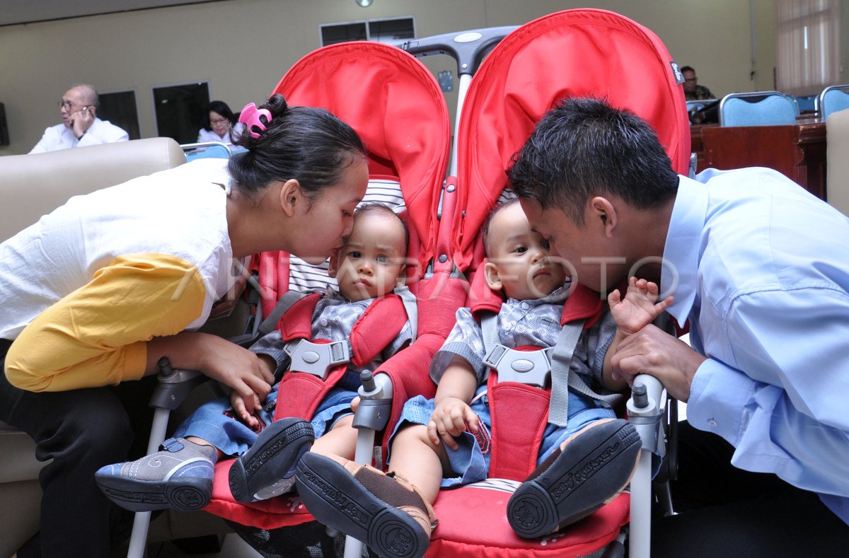 KEPULANGAN BAYI KEMBAR SIAM DI MEDAN | ANTARA Foto