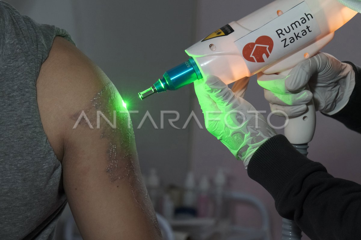 PROGRAM HAPUS TATO GRATIS ANTARA Foto