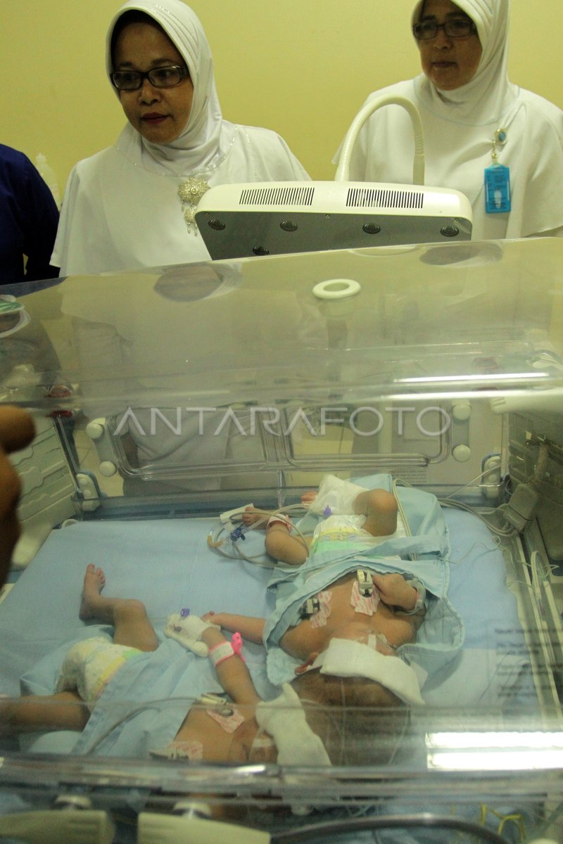 KELAHIRAN BAYI KEMBAR SIAM | ANTARA Foto